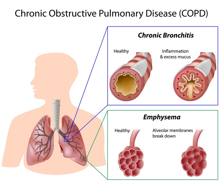 copd diagram