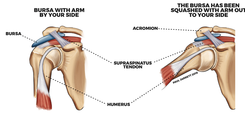 bursitis of the shoulder