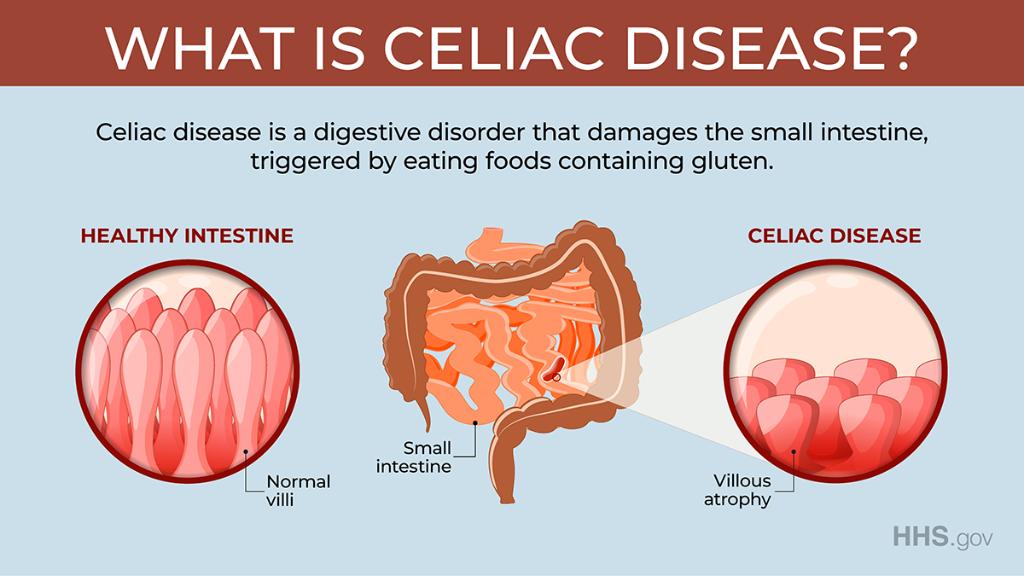 abnormal weight loss celiac disease