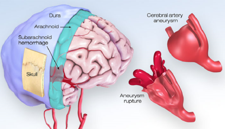 brain aneurysm