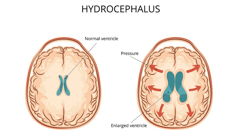 brain aneurysm hydrocephalus