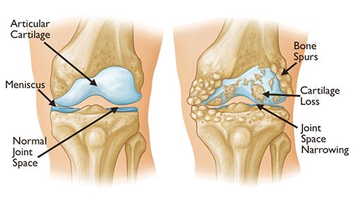 degenerative arthritis knee