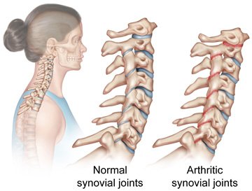 back pain and arthritis - rheumatoid arthritis