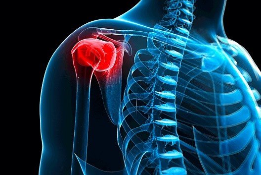 bursitis of the shoulder blue