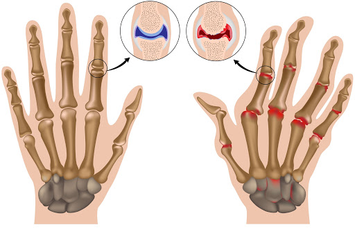 traumatic arthritis