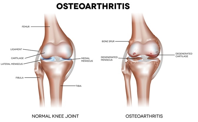 benefits for arthritis Osteoarthritis