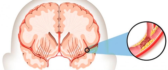 Stroke Rehabilitation Process