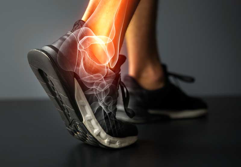 Pain from plantar fasciitis radiating through the ankle of a veteran